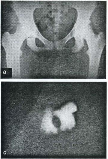 Osteoid osteoma 357 Şekil2: 13 yaşında bayan olgu ya ait femurda subtrokanterik bölgede, intrakortikal yerleşimli leıyonunun; a. AP ve, b. lateral radyogramlarla görünümü, C.