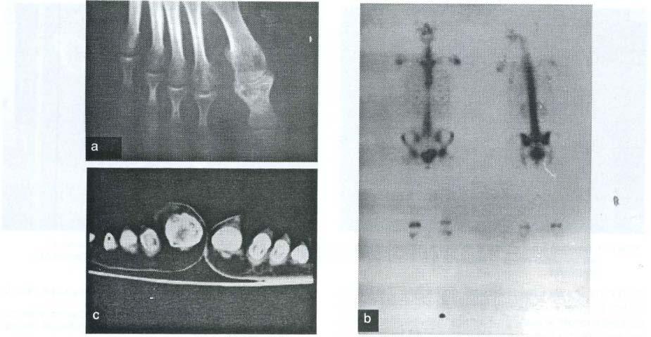 Osteoid osteoma 359 Şekil 7: 16 yaşında bayan olguda; a. sol ayak 1. parmak proksimal Ilanks yerleşimli lezyonun radyoloiik görünümü, b.