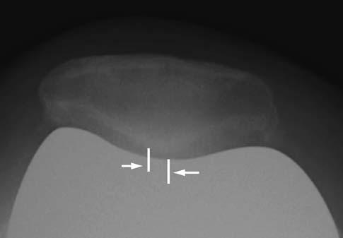 Patellar kayma endeksinin yüzeysel geçerlili i radyografik patellofemoral uyum ölçümlerinin hesaplanmas na kat lmayan 4 ortopedik cerrah taraf ndan test edildi.