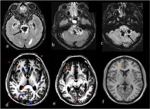 Frontoparietal asosiasyon korteksinde aktivite (beyaz oklar, i) (Kısaltma ve detaylar için metne bakınız-olgu1). Resim 2.