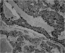 sağ ariepiglottik foldu tutan, aritenoide uzanım gösteren 3x2 cm boyutlarında, nodüler görünümde düzgün yüzeyli kitle mevcuttur (Resim 1). Resim 2.