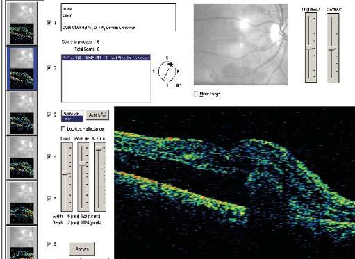 Ret - Vit 2005; 13 : Özel Sayı : 1-5 3 Resim 2: Olgunun preoperatif indosyanin yeşili anjiyogramları: a. Erken faz, b. Geç faz retina pigment epitel (RPE) değişikliği tespit edildi (Resim 1a,b).