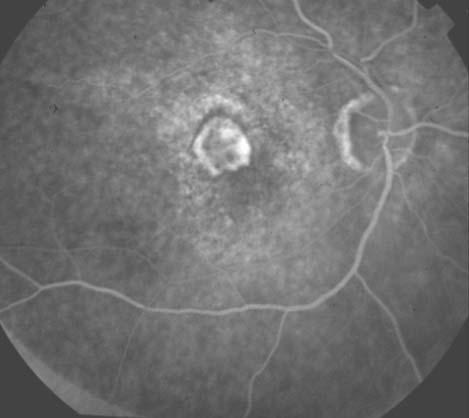 Ret - Vit 2005; 13 : 173-178 177 Resim 1: Bir AMD hastasýnýn tedavi öncesi ve tedaviden 3 ay sonraki FFA görüntüleri Tedaviden önce izlenen predominan klasik membranýn tedavi sonrasý 3.