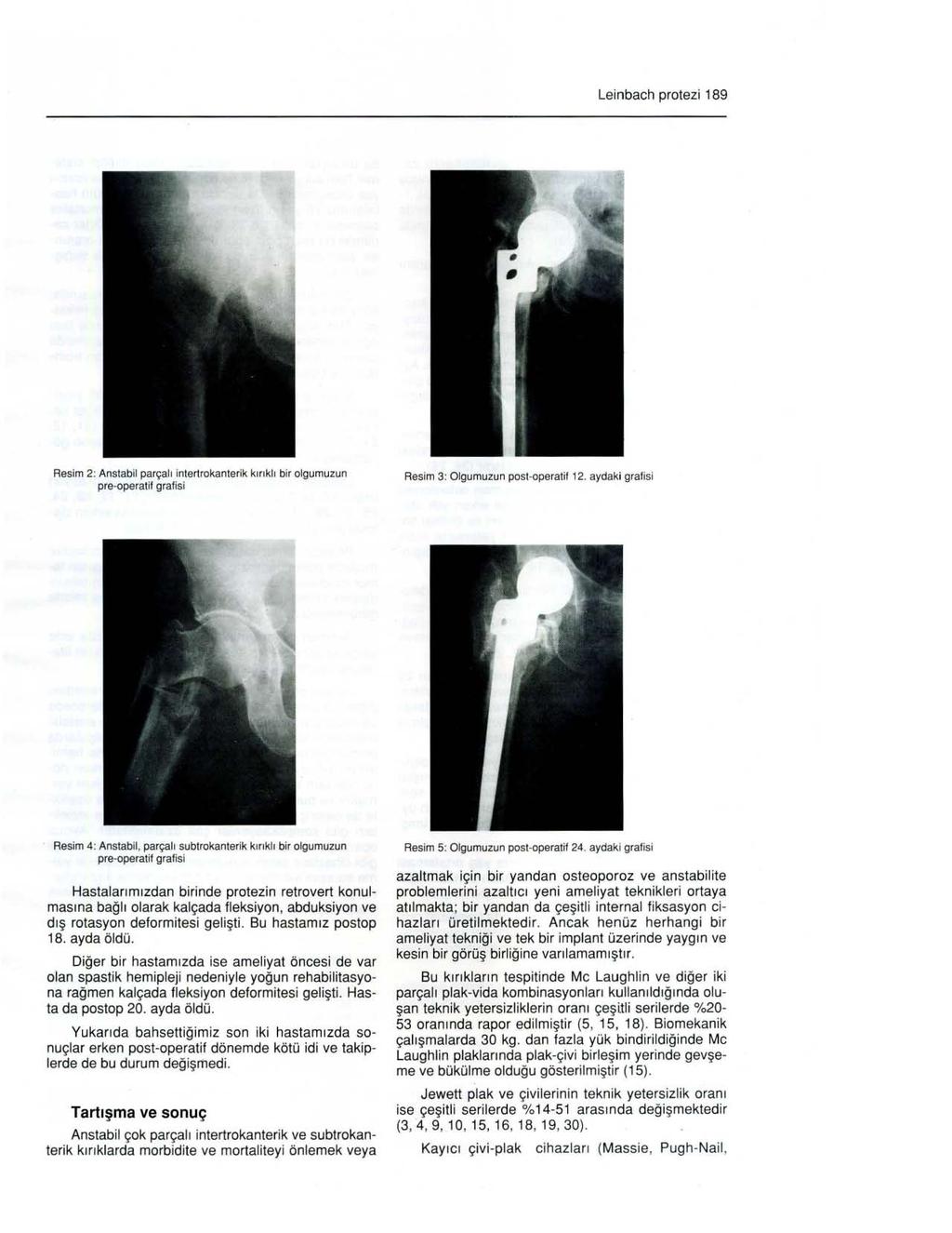 Leinbach protezi 189 Resim 2: AnsIabii parçal ı intertrokanterik kırıklı bir olgumuzun pre-operatif grafisi Resim 3: Olgumuzun post-operatif 12.