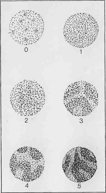 29 Spermatozoa hareketleri yavaş veya az sayıda ileri yönlü ise kitle hareketi ya çok yavaş dalgalanma veya kaynama şeklindedir ya da hiç görülmez.