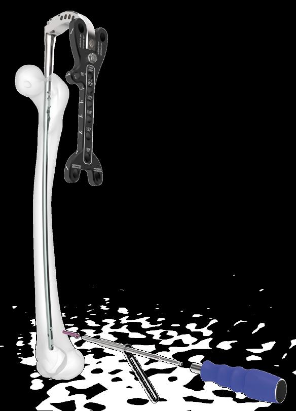 Distal kilitlemede serbest teknik (Freehand) kullanılması gerekir. Radyolusent x-ray masası, süreci kolaylaştırır. Çivi ucu ve distal kilitleme deliği skopi altında görülecek pozisyona ayarlanır.