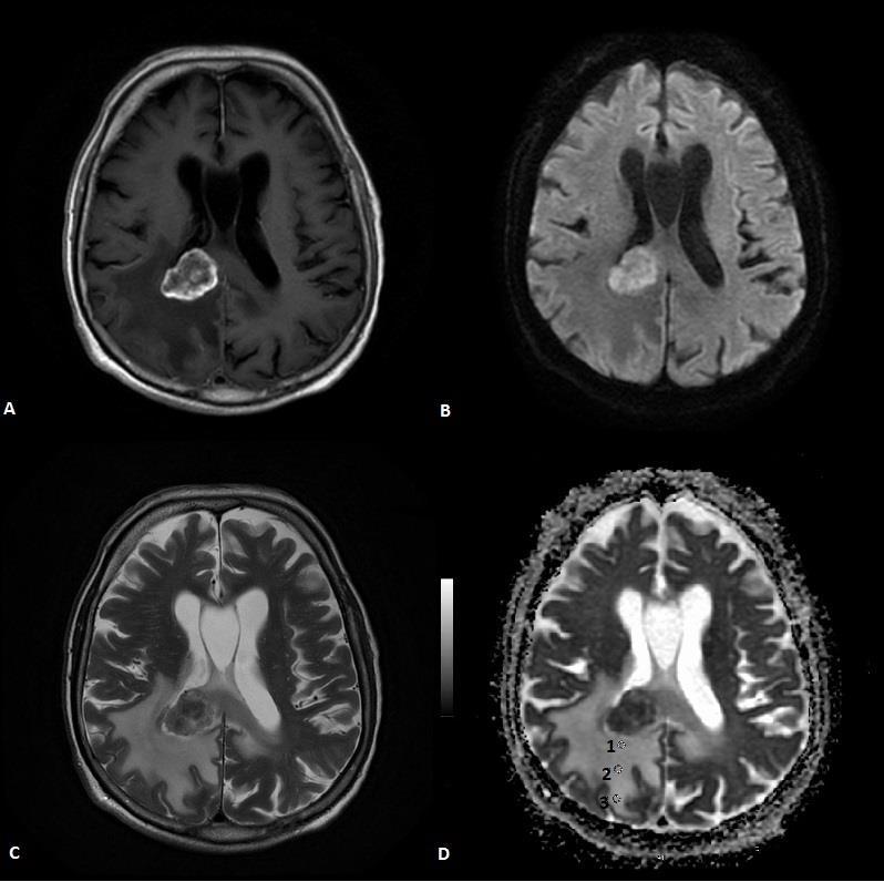 29 Olgu 3: 83 yaşında erkek, akciğer CA soliter beyin metastazı tanılı hasta; a. Kontrastlı T1 AG, b. Difüzyon ağırlıklı görüntüleme (b=1000), c. T2 AG, d.