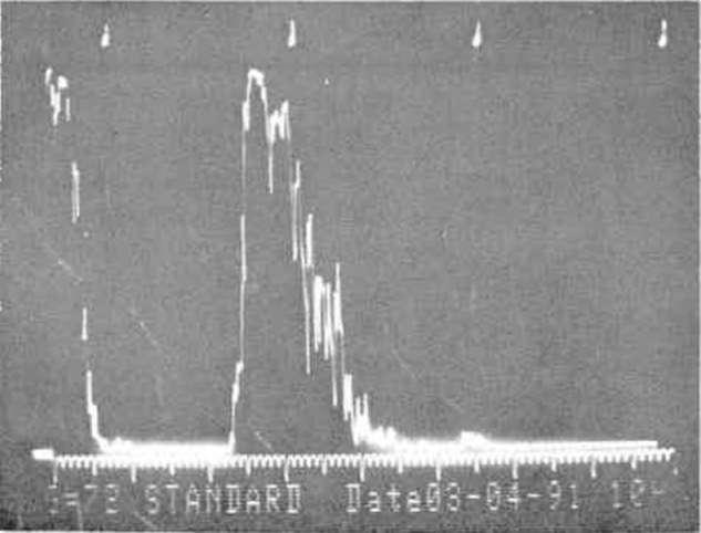 OFTALMOLOJİ ARALIK 1994 CİLT 3 SAYİ 4 Sekili A,B scan ekogram, kubbe şeklinde seröz koroıd dekolmanı ve sığ retina dekolmanı. dekolmanı oluşabilir (Şekil 1 A, B).