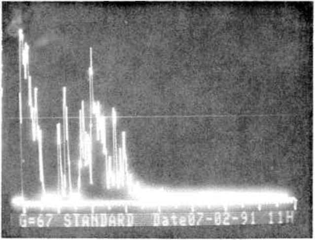 OFTALMOLOJİ ARALİK 1994 CİLT 3 SAYI 4 Şekil 4 A. B s can ekogram; hipotoni bulunan bir gözde, ön-arka eksende kısalma, korioretinal tabakada kalınlaşma ve retina deko İmanı. Şekil 4 B.