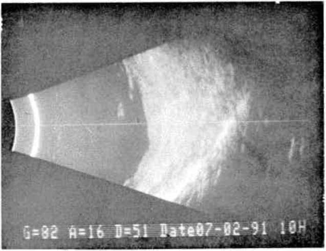 Genç nanoftalmuslu hastalar; genellikle katarakt gözlüklerine benzer gözlüklerle, iyi görme keskinliğine sahiptirler.