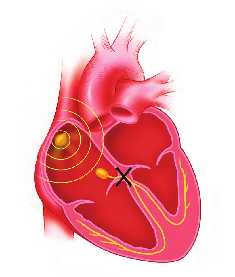 Brakardi sırasında, kalbin bölmeleri yeterli sıklıkta kasılmayarak, vücudunuza gerekli miktarda kanı sağlayamaz.