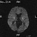 d) ADC haritasında infarkt alanı hipointensdir (kısıtlanmış difüzyon) B. Diğer Klinik Uygulamalar:Difüzyon MR ile epidermoid kist araknoid kistten ayrılabilir (88).