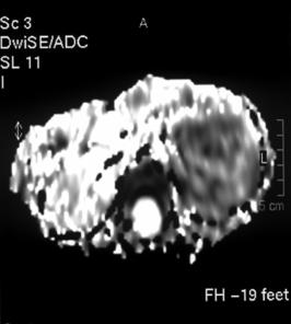 5 cm boyutta heterojen kitle (Wilm s tümörü), a) T2 ağırlıklı