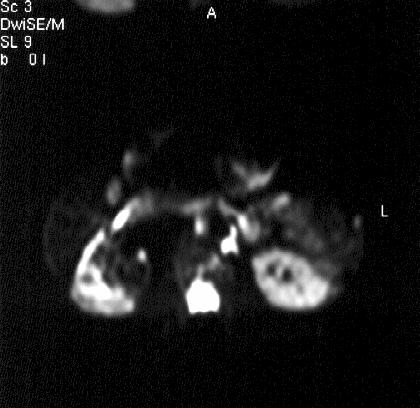 3x3,2 cm boyutta kitle (renal apse),