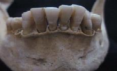 Grafik 7: Laodikeia Toplumunun Diş Gruplarına göre Antemortem Diş Kaybı Dağılımı Periyodontal hastalık alveolar kemik kaybı ile karakterize edilir.