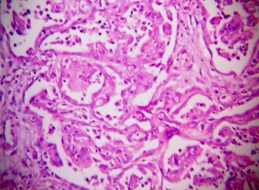 3.3.1.4.1. Epiteloid Mezotelyoma Epiteloid sitomorfoloji gösterir. Epiteloid mezotelyomaların çoğu dikkate değer şekilde sakindir fakat nadiren daha anaplastik biçimler görülür.