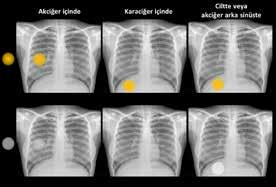 Radyografinin Temel Prensipleri ve Radyografik Yorumda Temel İlkeler 13 Resim 15.