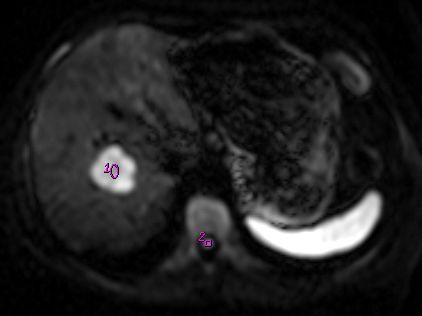 LAVA portal faz (B) görüntülerde periferik nodüler