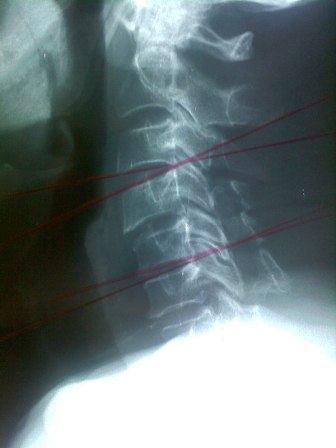 Her olguda preoperatif ve postoperatif cerrahi girişim uygulanacak veya uygulanan intervertebral disk veya disklerin alt ve üst intervertebral disk aralıklarında nötr, hiperfleksiyon ve