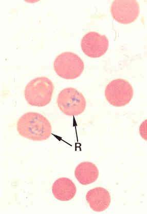 RETİKULOSİT (POLİKROMATOFİLİK ERİTROSİT) KREZİL