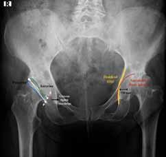 perolateral noktasında kesişiyorsa asetabulum anteverttir. Bu çizgiler superolateral noktaya ulaşmadan kesişiyorsa retroverttir. Şekil 1.