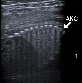 İkinci Trimester Ultrasonografi İncelemesi 207 Resim 6. Lineer probla akciğer ekojen yapıda detaylı görülebilir.