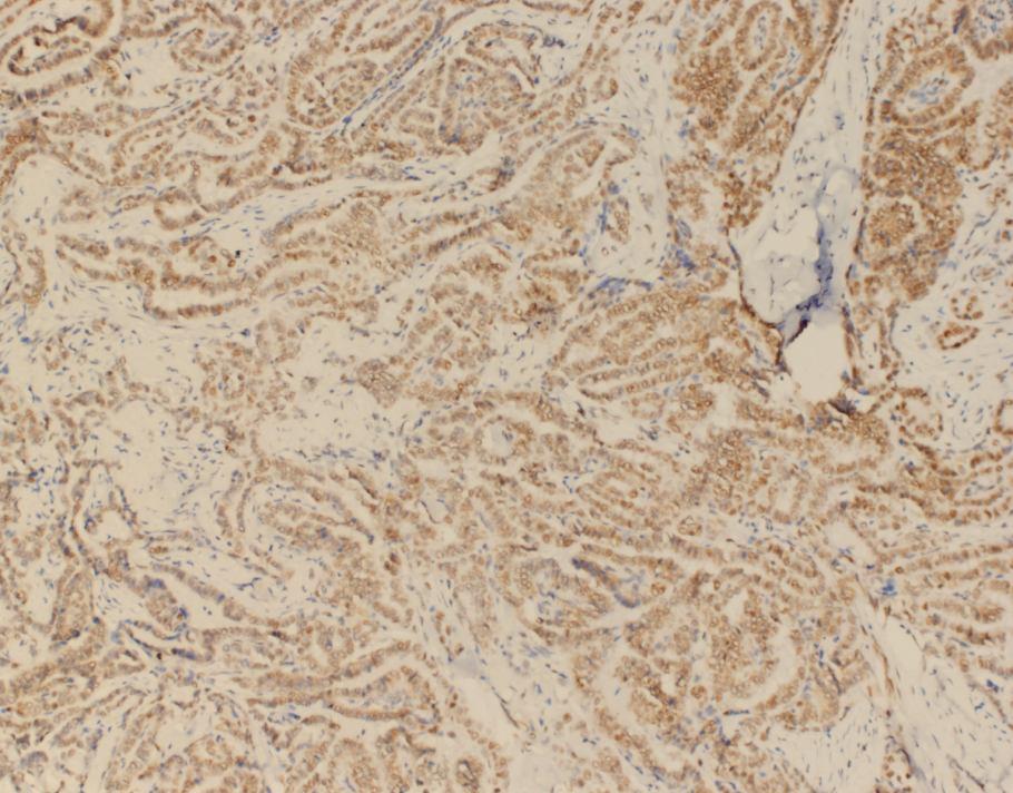 Tiroidit 13,8 82,8 3,4 Kolloidal Guatr 80,8 19,2 - İmmunohistokimya değerlendirmeleri; Resim 17: Tiroid