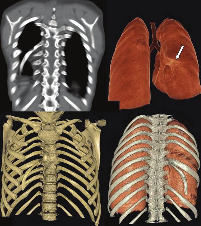 J Kartal TR 2011;22(3):135-144 doi: 10.5505/jkartaltr.2011.53496 (c) Şekil 10. Koronal planda toraks BT; (b-d) 3D BT görüntülerde; 7. torakal vertebra düzeyinden kaynaklanan 7.