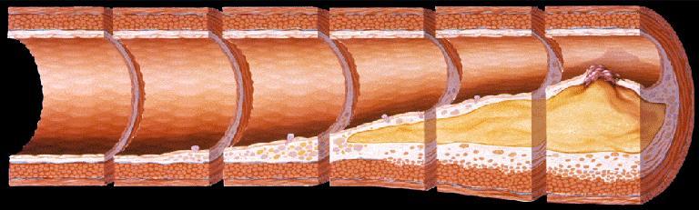Aterosklerozun doğal seyri Köpük hücreleri Yağlı Orta dereceli çizgilenme lezyon Aterom Fibröz plak