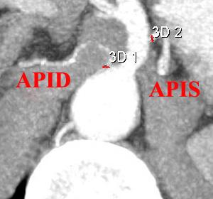 - AA nın ARS seviyesinde transvers çap ölçümü. - AA nın ARS seviyesinde sagittal çap ölçümü.