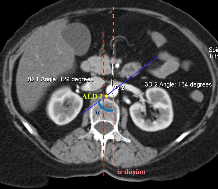 - ALD 2 nin reformat aksiyal görüntü üzerinden AA dan çıkış açı ölçümü