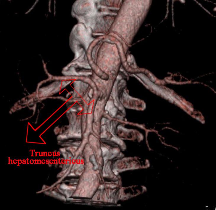 Şekil 3.17. Truncus hepatomesentericus.