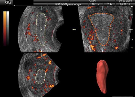 3D Power Doppler ile Endometrial Akım Ölçümü