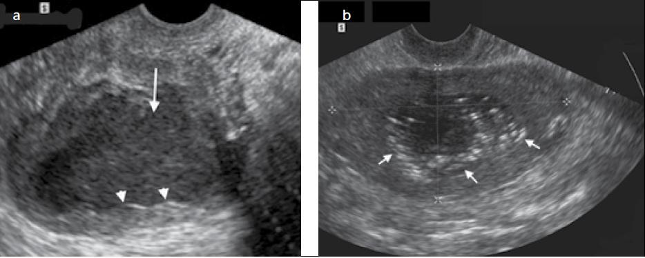 a, b. Endometrit.