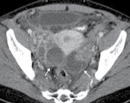 Tuboovarian abse; Aksial BT de bilateral adneksal alanda duvarı