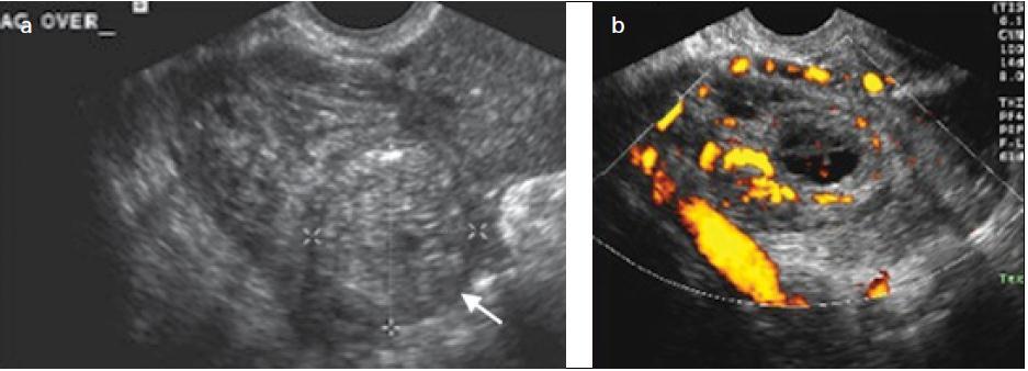 a, b. Ektopik Gebelik; (a) Gri skala US de sağ over lokalizasyonunda periferi hiperekoik santralde hipoekoik komponenti olan lezyon