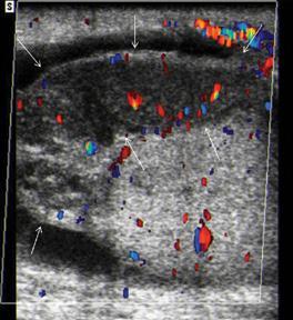 Akut epididimit; Renkli Doppler ultrasonda heterojen azalmış