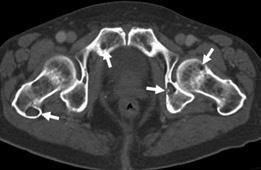 Multipl myeloma olgusunda kemik pencere BT görüntüsünde