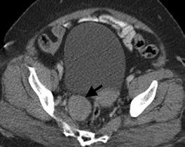 BT incelemesinde insidental olarak saptanan sağ pelvik yan duvar yerleşimli ve homojen