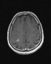Bu çalışmada, yukarıda bahsedilen gereklilikler doğrultusunda, beyin tümörlerinin bölütlenmesinde kullanılan yöntemlerden FCM, Otsu, Bölge Büyütme ve SOM yöntemlerinin, beyin tümörlerinde bölütleme
