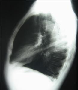 Lateral (sol yan) akciğer grafisi X-ışın tüpü Sol yan akciğer grafisinde x-ışınları