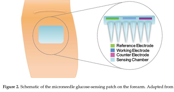 Mikroiğneler ve mikroiğne dizileri, mikroinvaziv olarak intertisyel sıvının algılanmasını sağladığı için geçen yıllarda ilgi görmeye