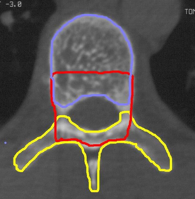 Hemanjiom Dev Hücreli Tümör Lenfoma Osteosarkoma