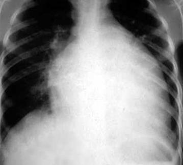 pulmoner konjesyon