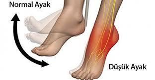 bozukluktur. Doğuştan olabildiği gibi, ayağın uzun süre hareketsiz kalması (alçı vb.), hızlı kilo kaybı, ağır yük taşıma ve ayağa uygun olmayan ayakkabı giyilmesine bağlı olarak da gelişebilir.