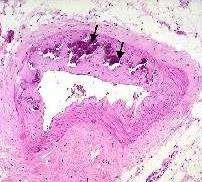Damar düz kas hücresi ÜREMİ HİPERFOSFATEMİ Osteoblast benzeri hücre Tip-I kollajen, matrix proteinleri Kalsifikasyon inhibitörleri: Fetuin-A, matrix GLA protein,