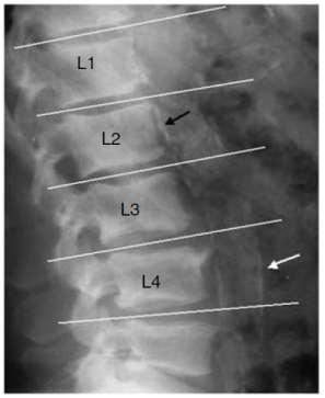 Kılavuzlar yeni diyaliz hastalarının vasküler kalsifikasyon açısından taranmasını desteklemektedir ERBP yeni diyaliz hastalarının lateral abdominal röntgen (veya kalsifiye kapaklar için