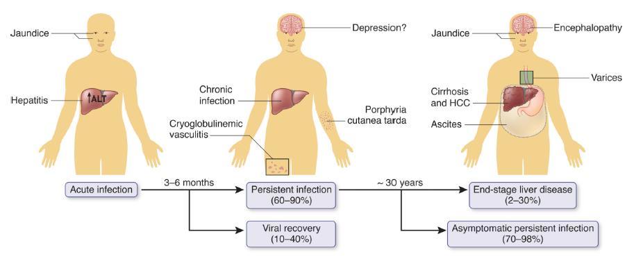 Hepatit C: Doğal seyir Thomas