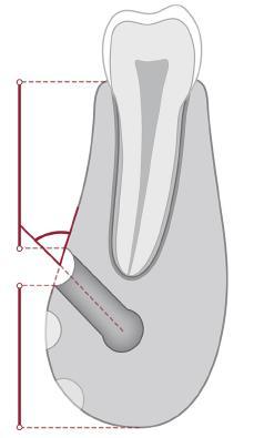 anteriora uzantı (loop) varlığı ve boyutu: Mandibular kanal bazı kişilerde mental