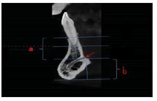 19 Lingual foramen lokalizasyonu, boyutu, kemik kretin üst ve alt sınırına mesafesi, lingual kanalın dallanması: Lingual